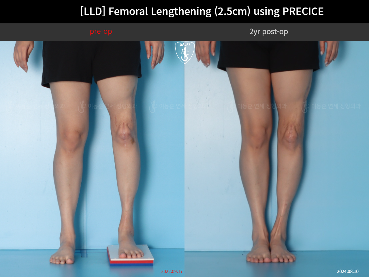 Before and after adult lld, case 89087135, image 5, Dr. Donghoon institute (DALRI)