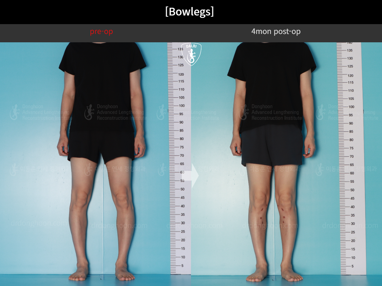 Before and after adult bowlegs, case 17962599, image 3, Dr. Donghoon institute (DALRI)
