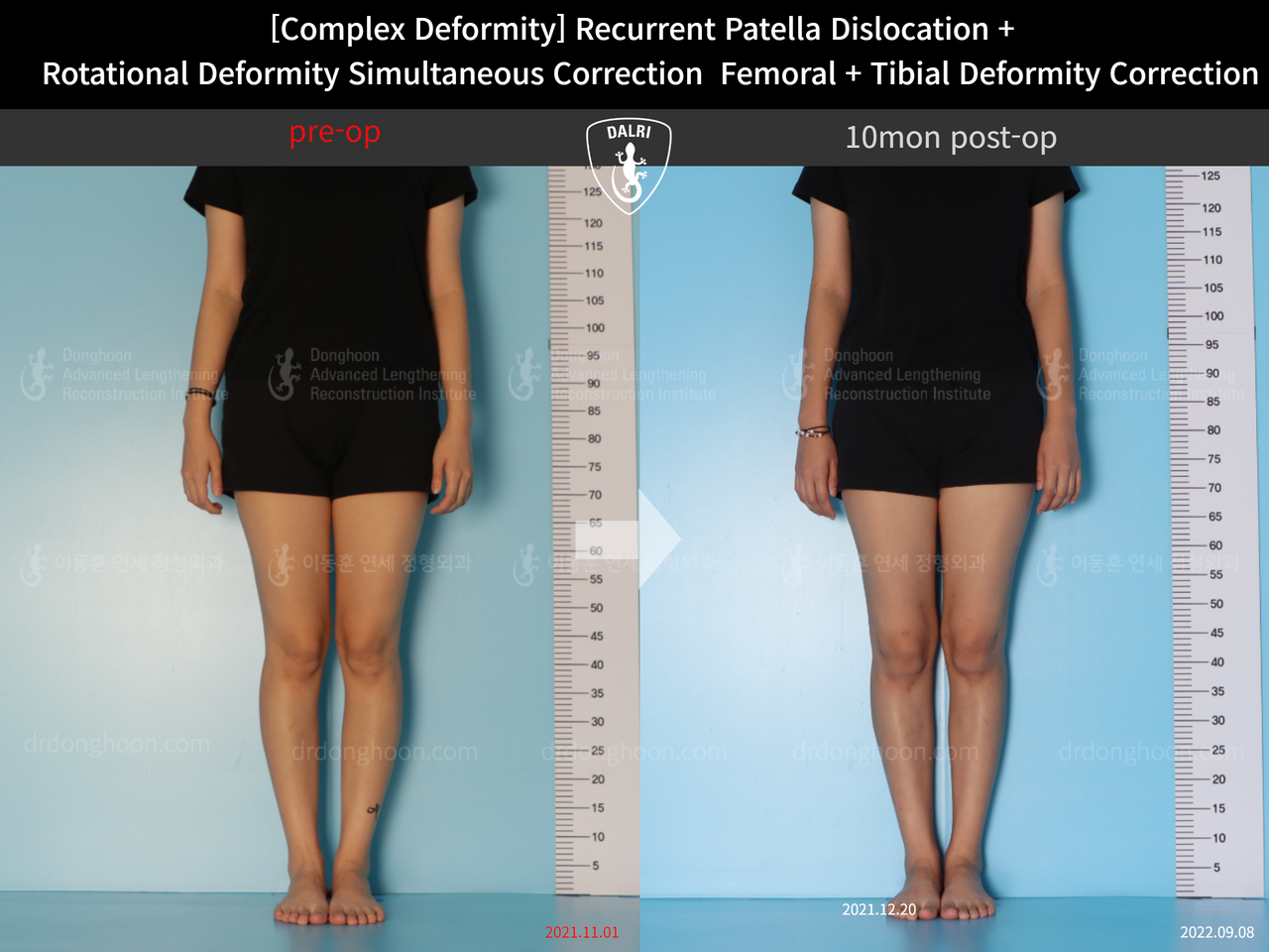 Before and after complex deformity, case 12860892, image 1, Dr. Donghoon institute (DALRI)