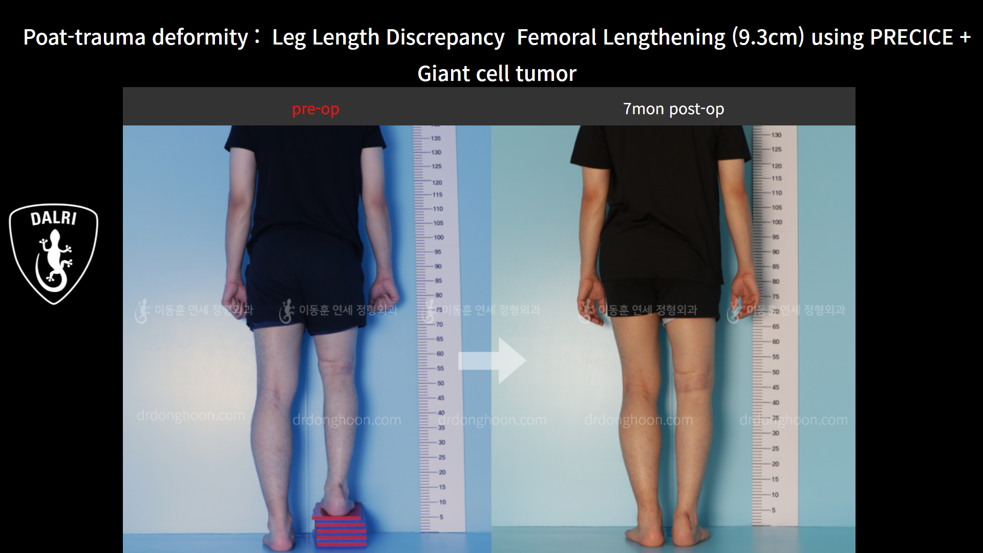 Before and after post-trauma deformity, case 8606746, image 2, Dr. Donghoon institute (DALRI)