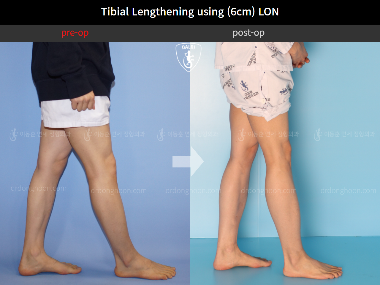 Before and after cll lon, case 4577694, image 7, Dr. Donghoon institute (DALRI)