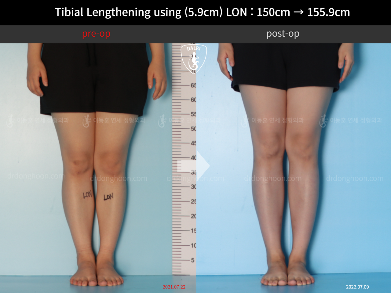 Before and after cll lon, case 12207071, image 5, Dr. Donghoon institute (DALRI)