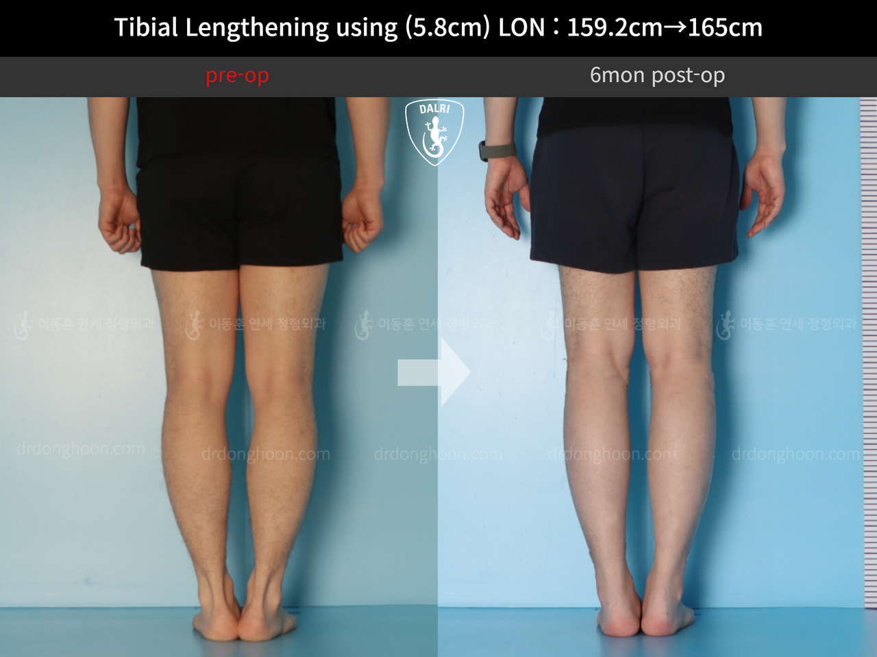 Before and after cll lon, case 12791053, image 6, Dr. Donghoon institute (DALRI)