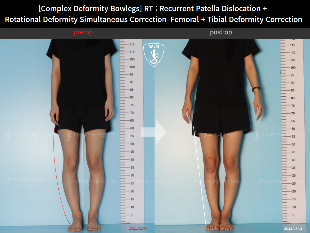 Before and after adult bowlegs, case 14960899, image 3, Dr. Donghoon institute (DALRI)