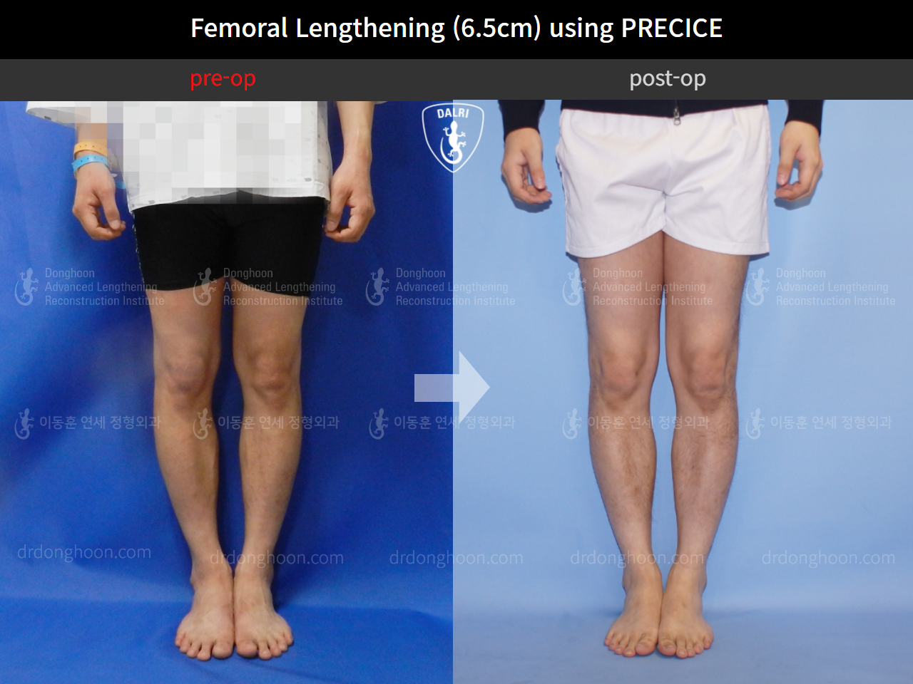 Before and after cll precice, case 4323401, image 5, Dr. Donghoon institute (DALRI)