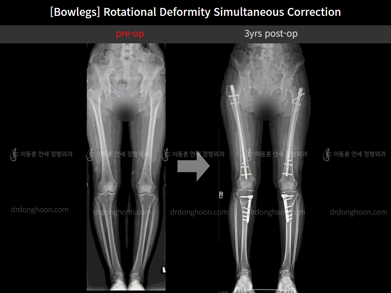 Before and after adult bowlegs, case 11789553, image 1, Dr. Donghoon institute (DALRI)