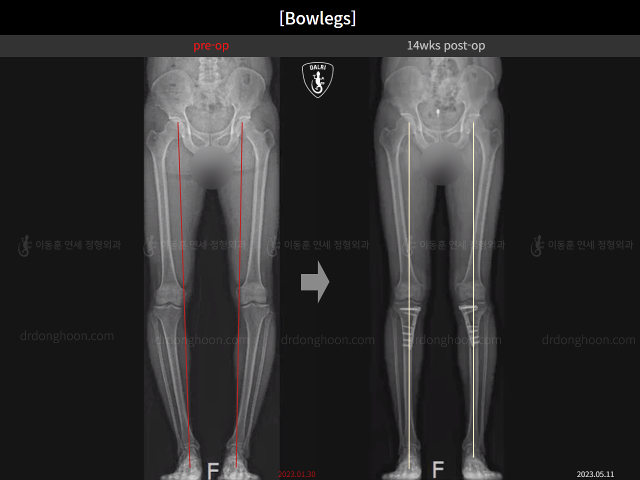 Before and after adult bowlegs, case 15512423, image 12, Dr. Donghoon institute (DALRI)