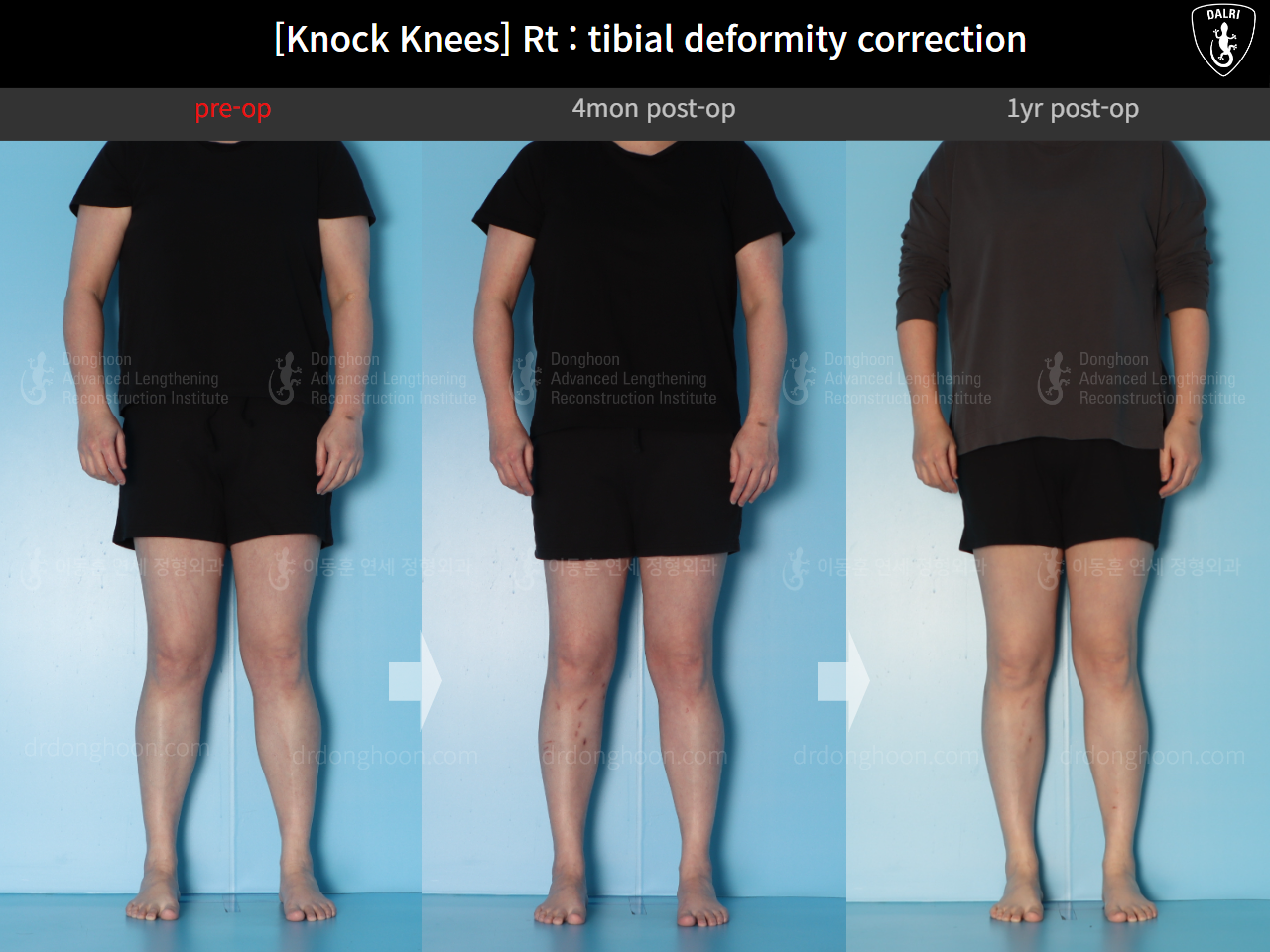 Before and after adult knock knees, case 18411627, image 3, Dr. Donghoon institute (DALRI)