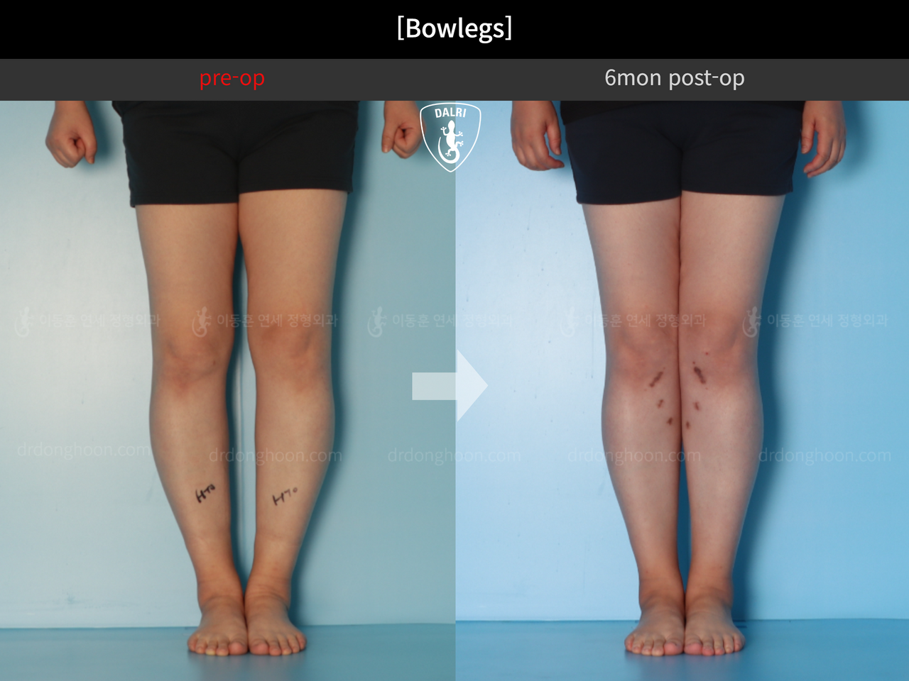 Before and after adult bowlegs, case 12396052, image 5, Dr. Donghoon institute (DALRI)