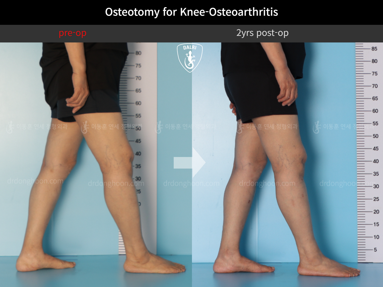 Before and after osteotomy for knee osteoarthritis, case 12844528, image 8, Dr. Donghoon institute (DALRI)