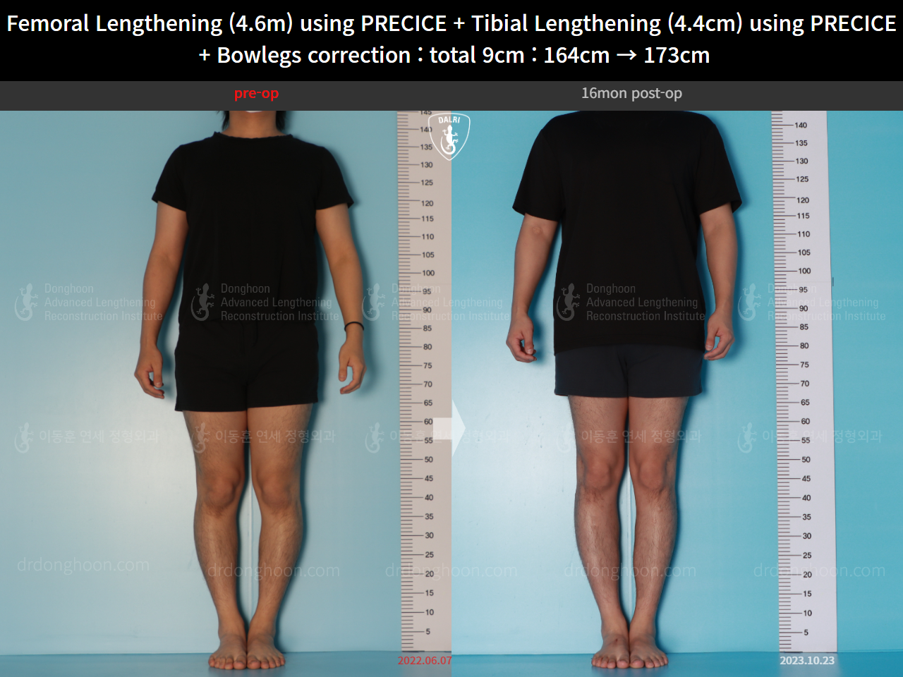 Before and after cll precice, case 16697524, image 1, Dr. Donghoon institute (DALRI)