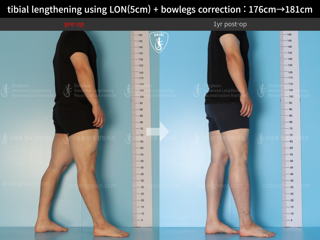 Before and after cll + deformity correction, case 13410849, image 5, Dr. Donghoon institute (DALRI)