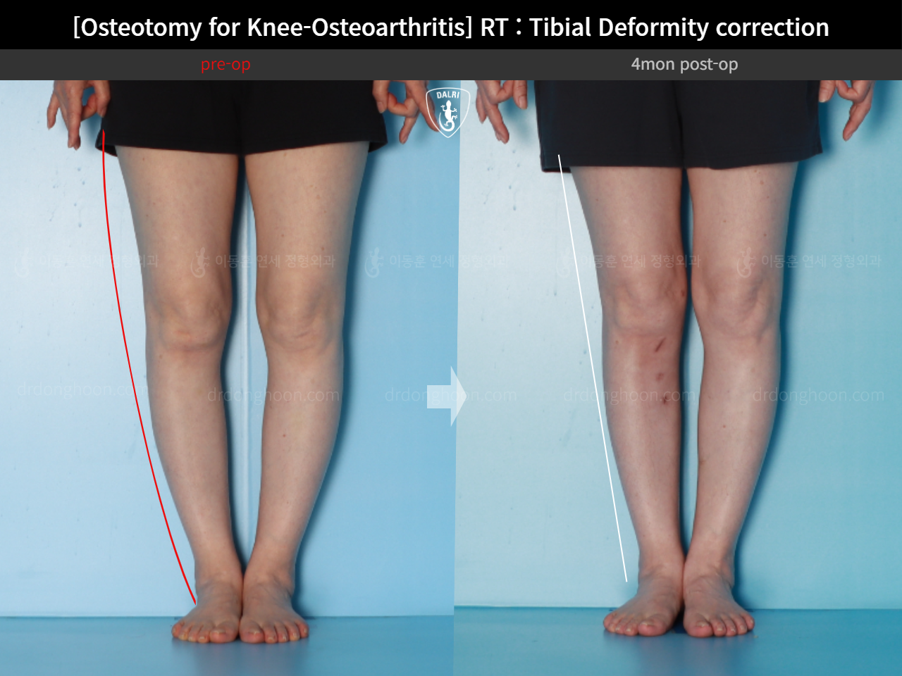 Before and after osteotomy for knee osteoarthritis, case 17890677, image 6, Dr. Donghoon institute (DALRI)