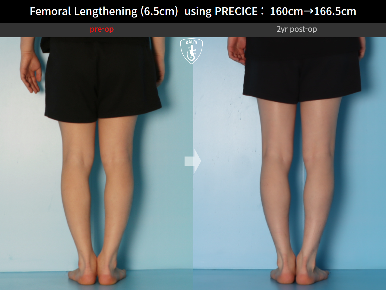 Before and after cll precice, case 27369651, image 8, Dr. Donghoon institute (DALRI)