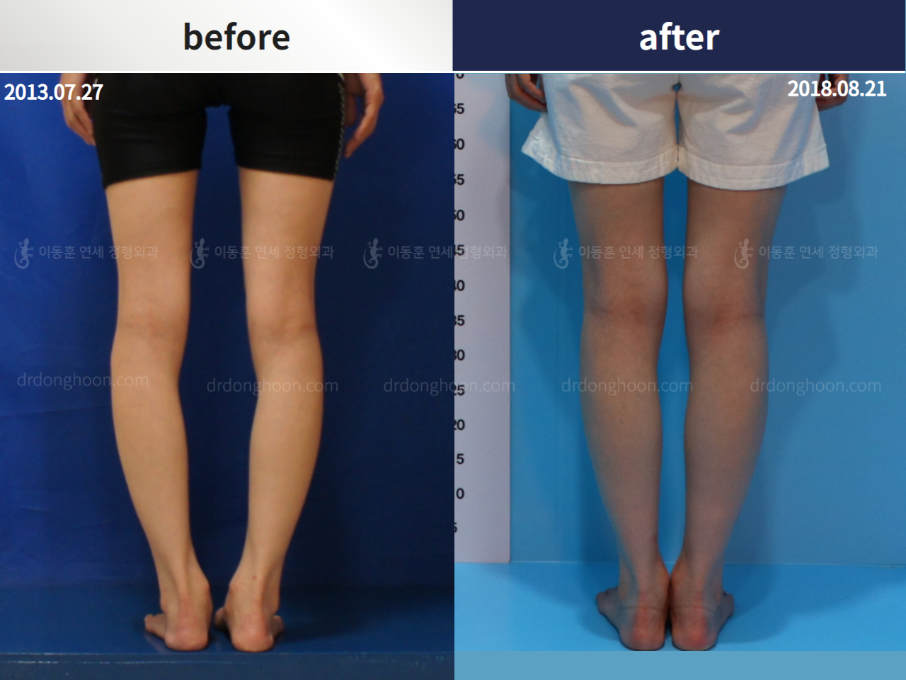 Before and after complex deformity, case 4297345, image 2, Dr. Donghoon institute (DALRI)