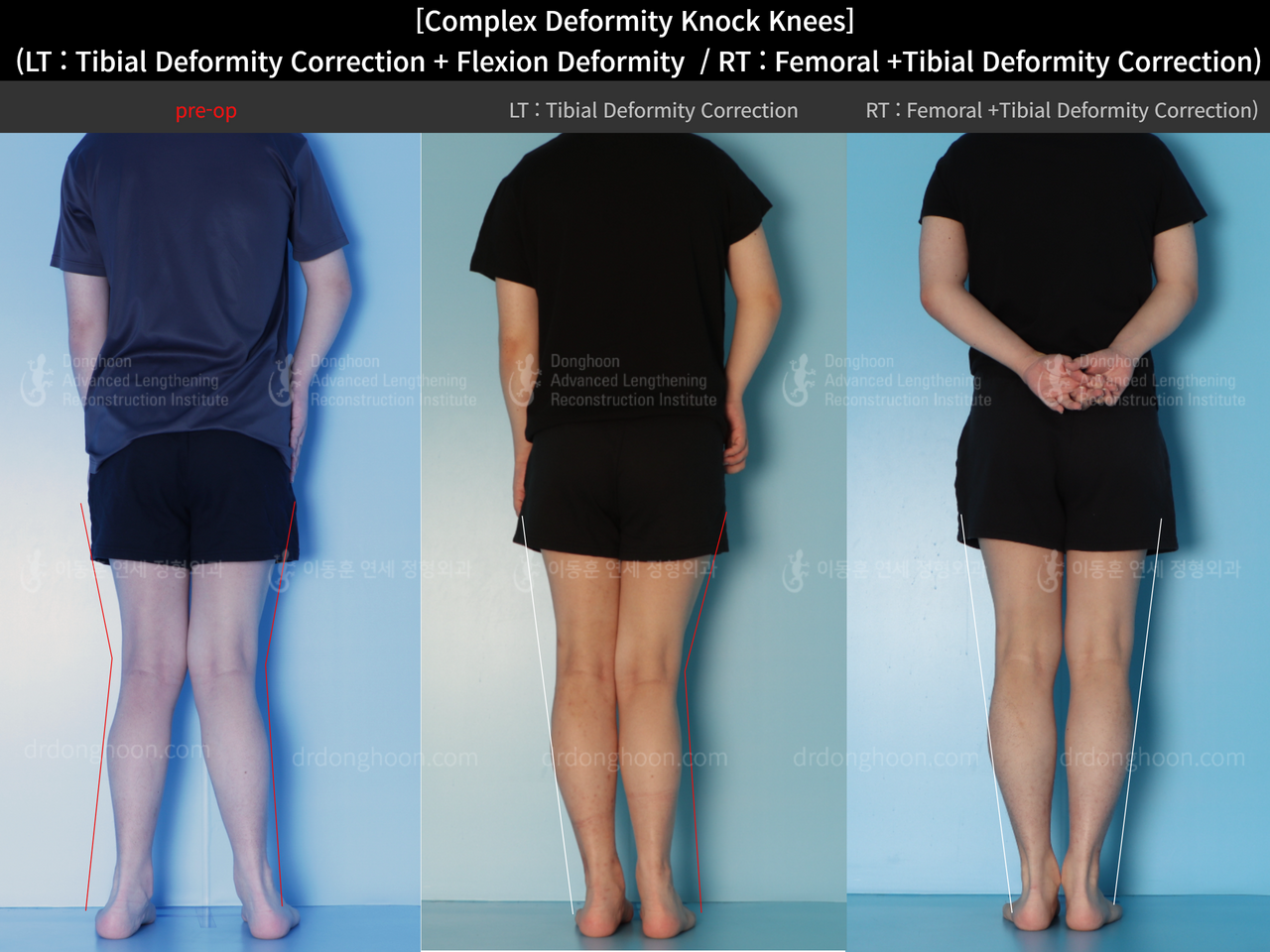 Before and after adult knock knees, case 14439339, image 2, Dr. Donghoon institute (DALRI)