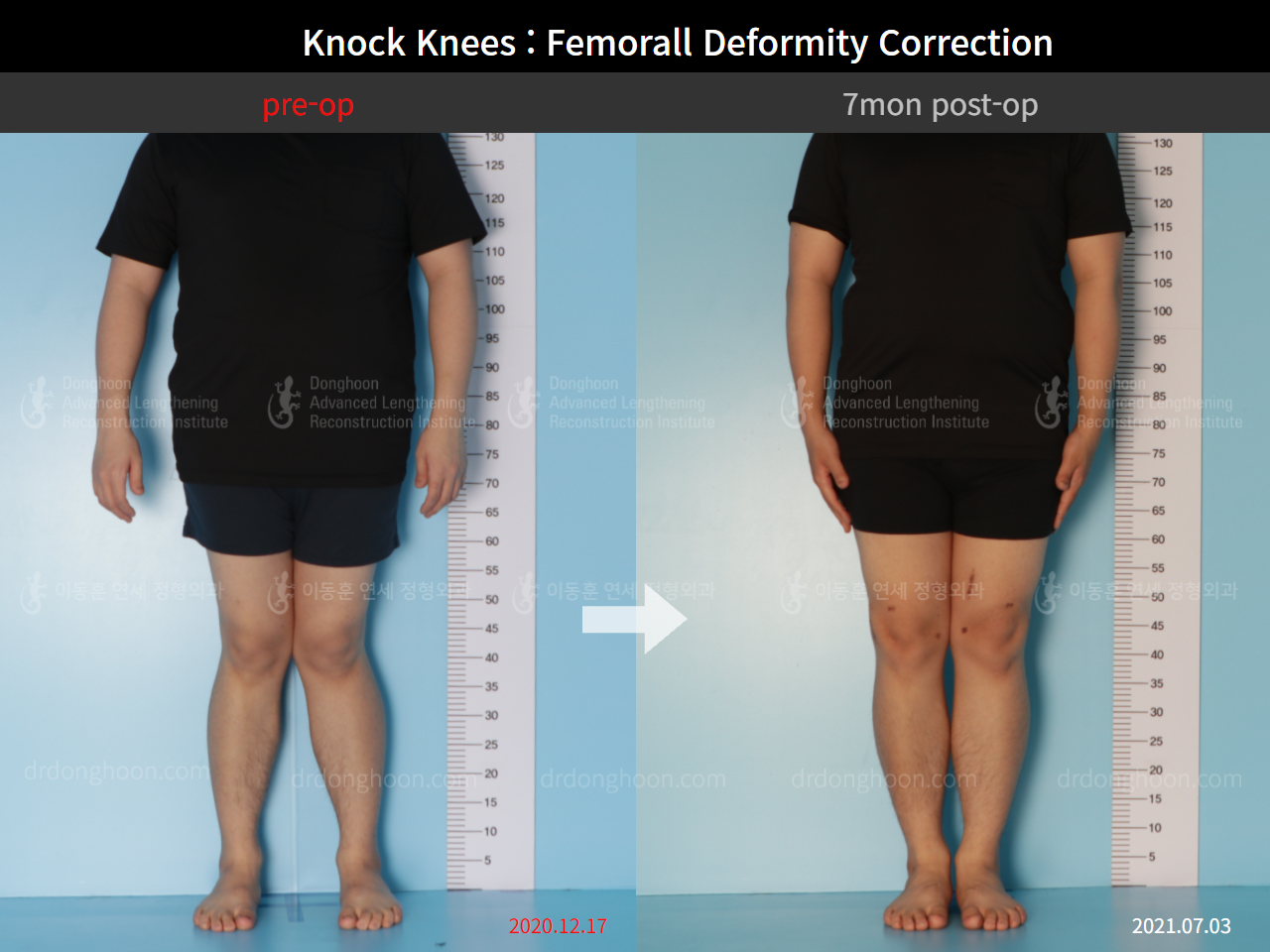 Before and after adult knock knees, case 8821218, image 3, Dr. Donghoon institute (DALRI)