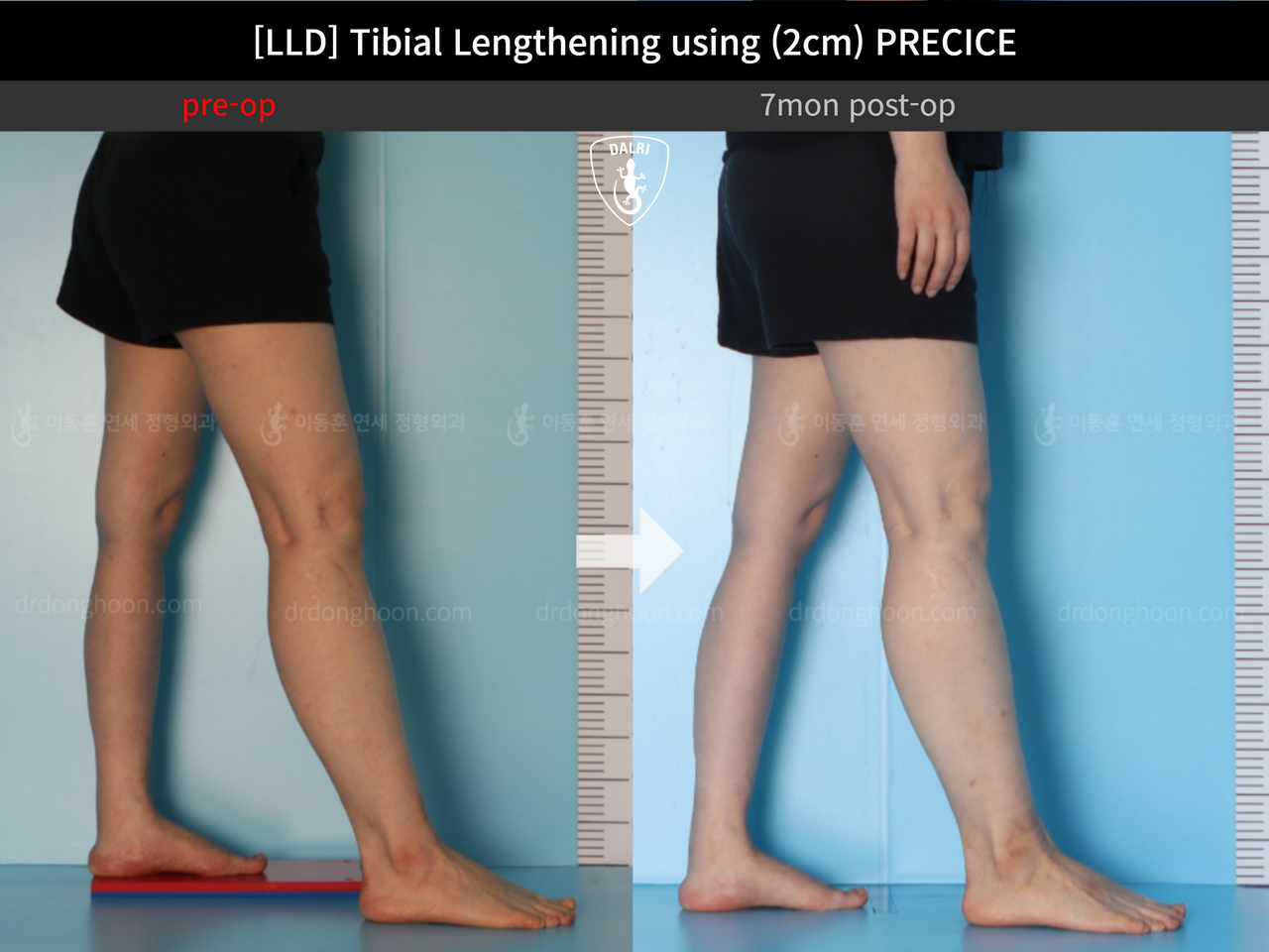 Before and after adult lld, case 12985023, image 8, Dr. Donghoon institute (DALRI)