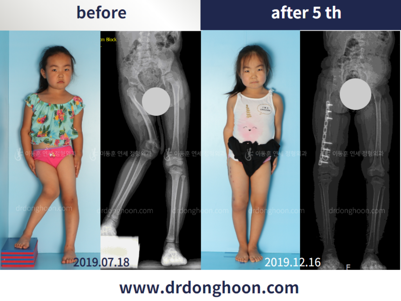 Before and after paediatric & adolescent lld, case 4577152, image 2, Dr. Donghoon institute (DALRI)