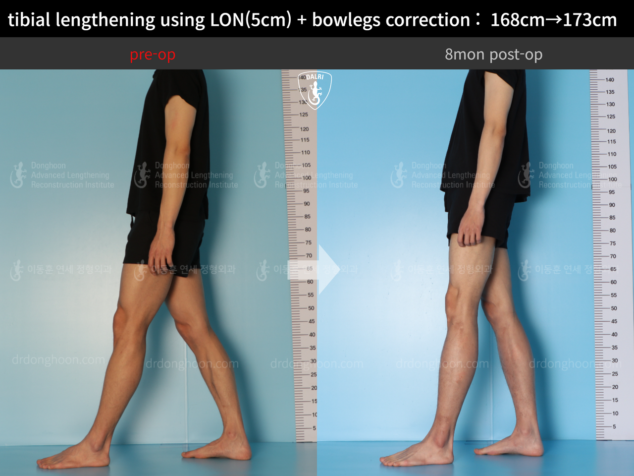 Before and after cll lon, case 13661175, image 5, Dr. Donghoon institute (DALRI)