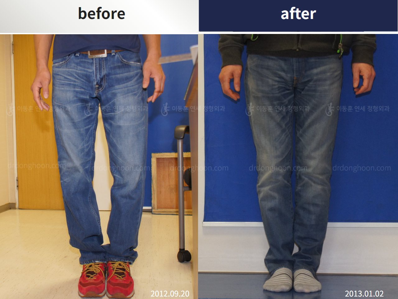 Before and after adult bowlegs, case 4311126, image 2, Dr. Donghoon institute (DALRI)