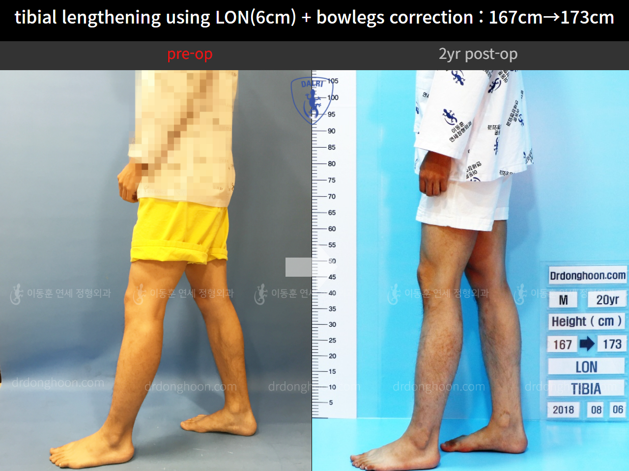 Before and after cll + deformity correction, case 4323147, image 3, Dr. Donghoon institute (DALRI)