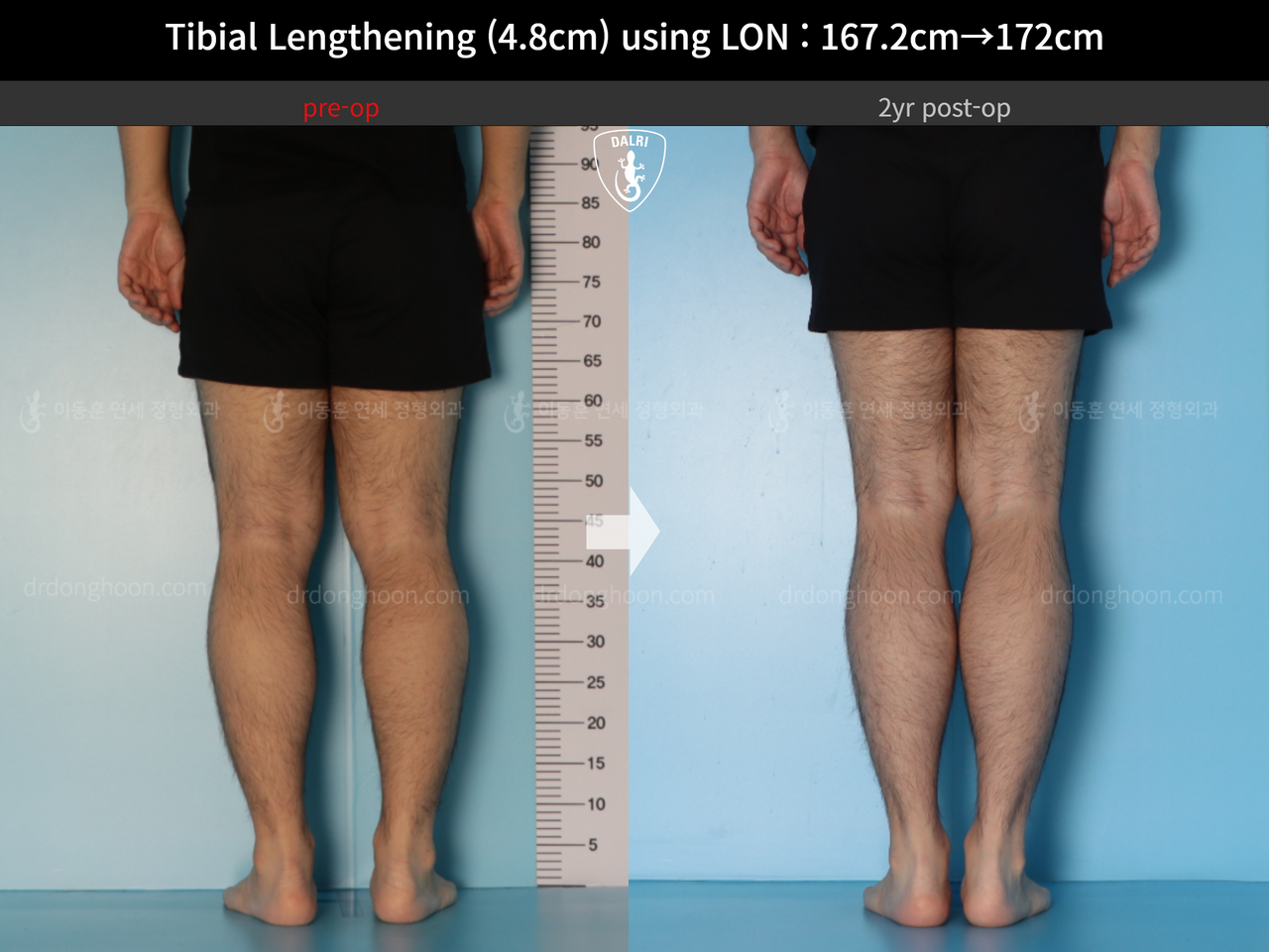 Before and after cll lon, case 14418932, image 6, Dr. Donghoon institute (DALRI)
