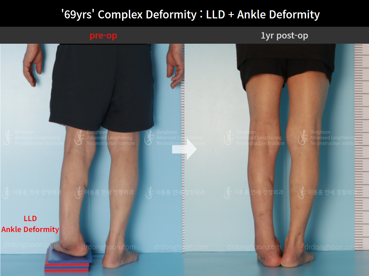 Before and after adult lld, case 8981713, image 4, Dr. Donghoon institute (DALRI)