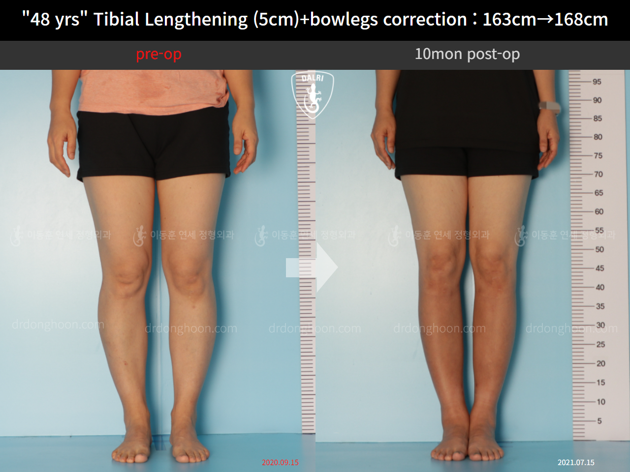 Before and after cll precice, case 10474341, image 5, Dr. Donghoon institute (DALRI)