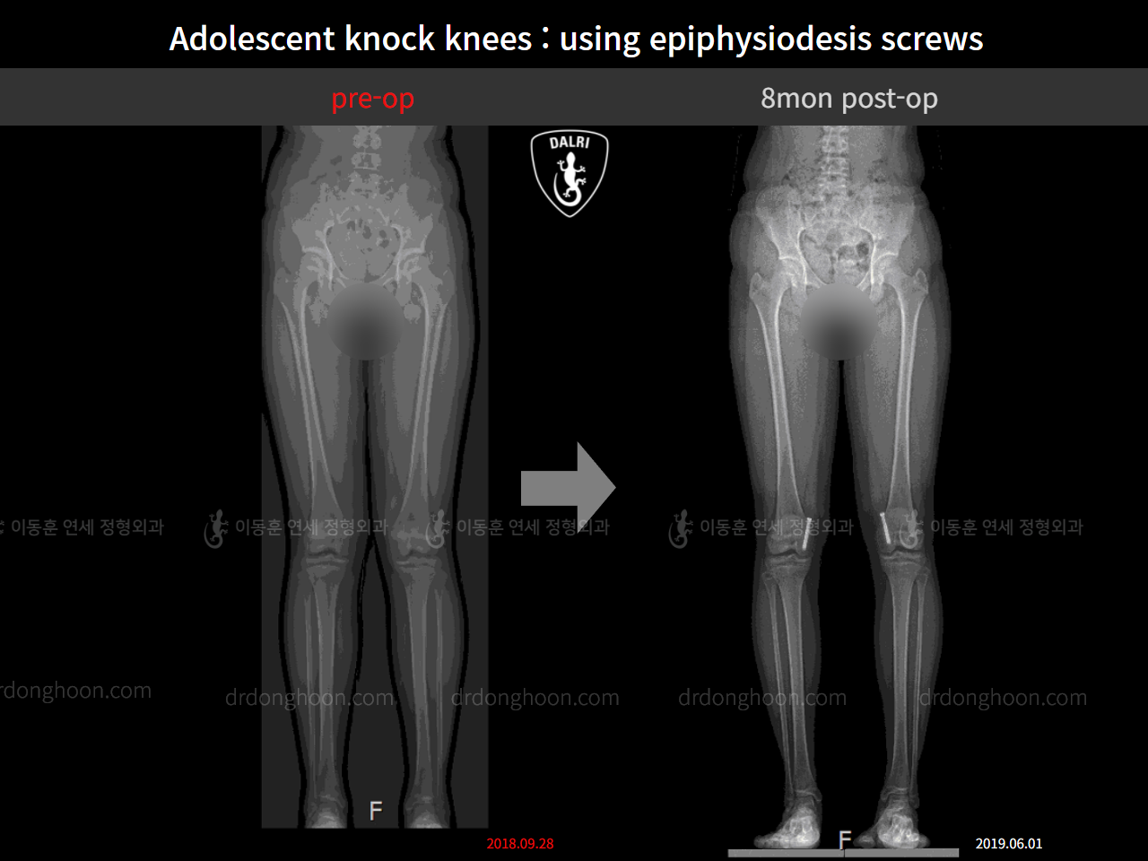 Before and after paediatric & adolescent knock knees, case 4310931, image 5, Dr. Donghoon institute (DALRI)