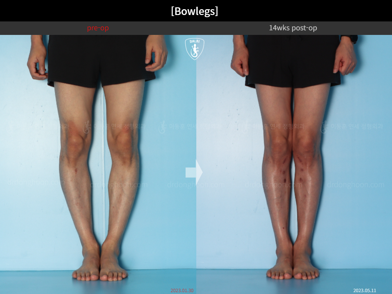 Before and after adult bowlegs, case 15512423, image 6, Dr. Donghoon institute (DALRI)