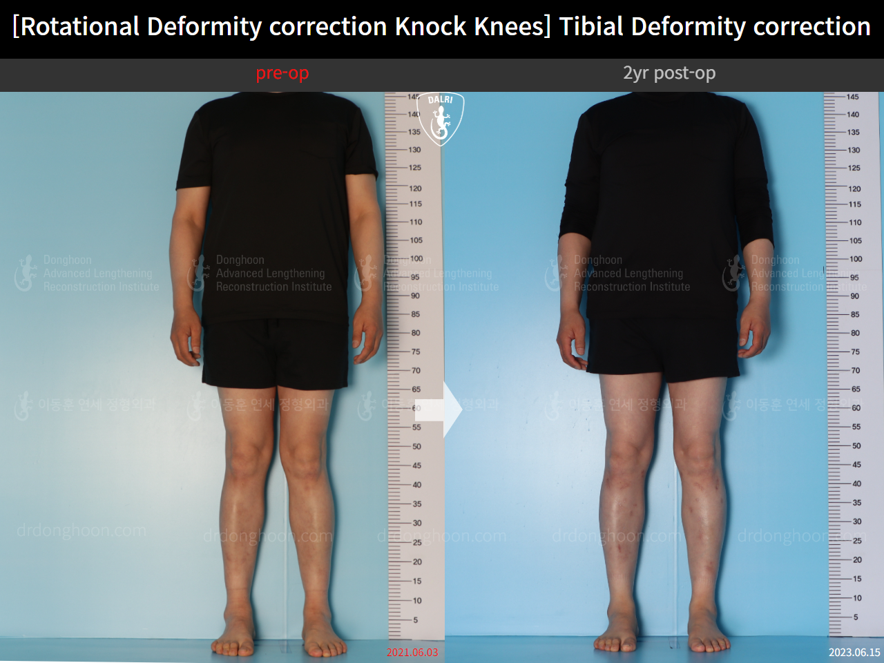 Before and after adult knock knees, case 15524370, image 2, Dr. Donghoon institute (DALRI)