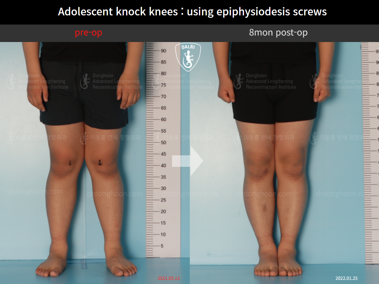 Before and after paediatric & adolescent knock knees, case 9743785, image 3, Dr. Donghoon institute (DALRI)