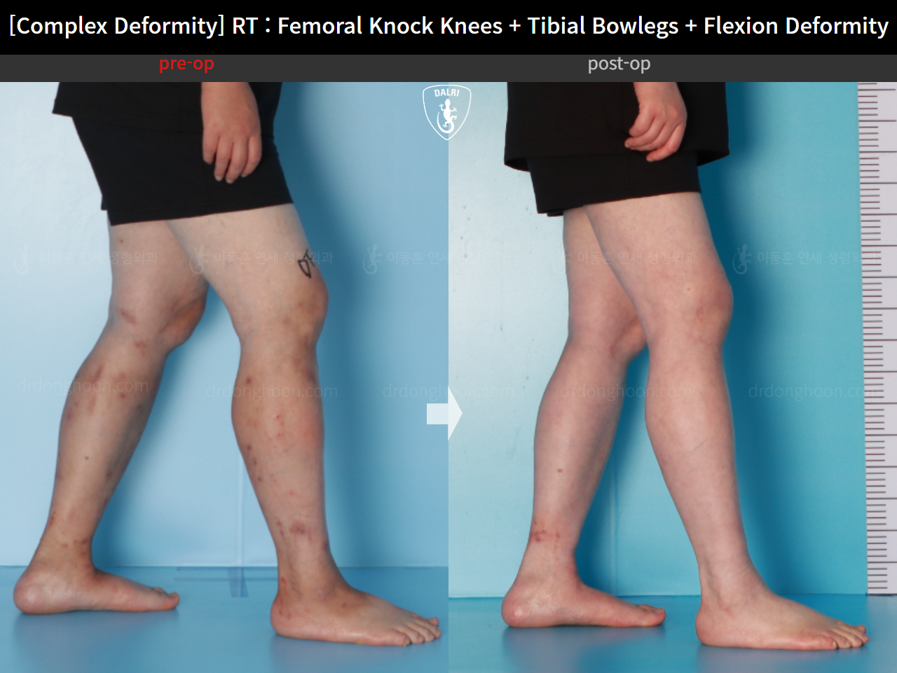 Before and after adult knock knees, case 16507042, image 8, Dr. Donghoon institute (DALRI)