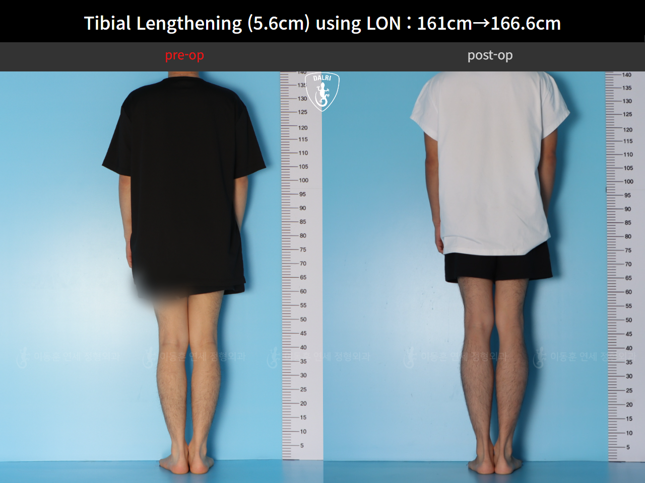 Before and after cll lon, case 126542150, image 2, Dr. Donghoon institute (DALRI)
