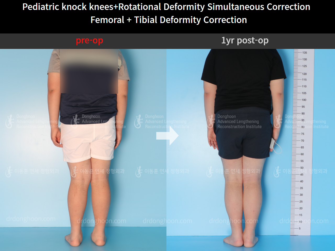 Before and after paediatric & adolescent knock knees, case 4640495, image 2, Dr. Donghoon institute (DALRI)
