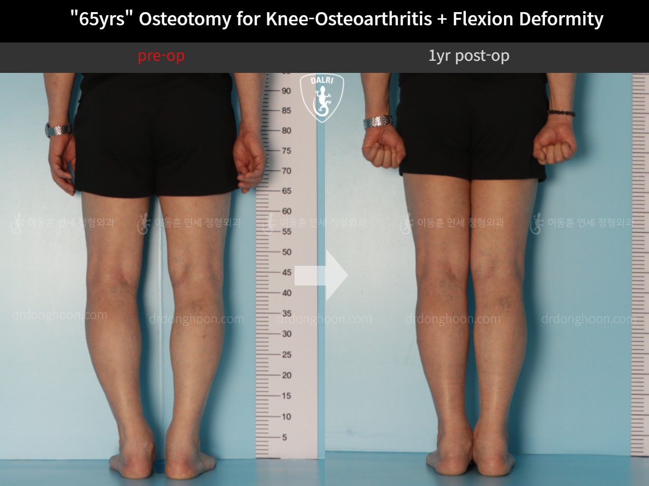 Before and after osteotomy for knee osteoarthritis, case 10742820, image 4, Dr. Donghoon institute (DALRI)