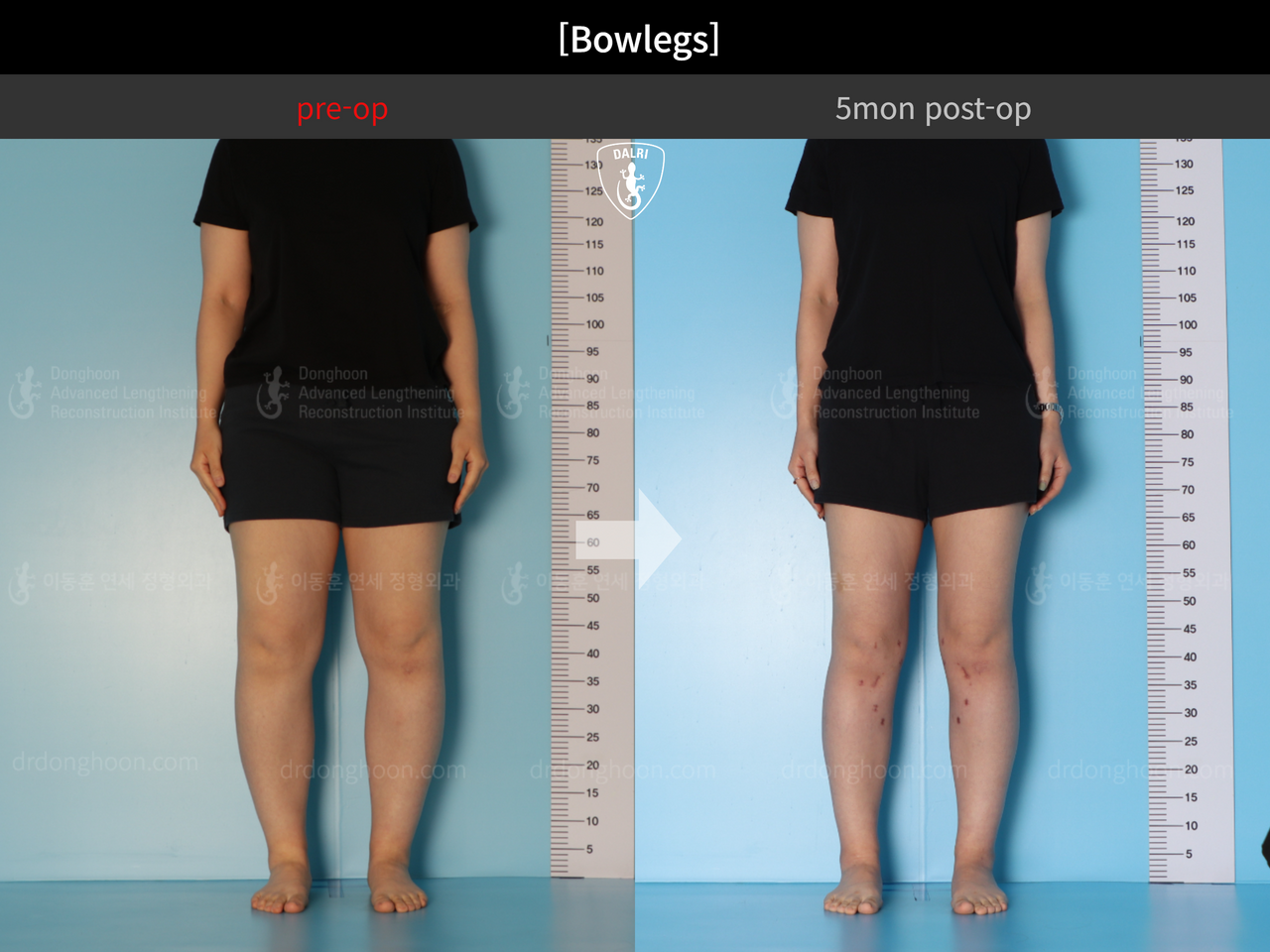 Before and after adult bowlegs, case 13212059, image 3, Dr. Donghoon institute (DALRI)