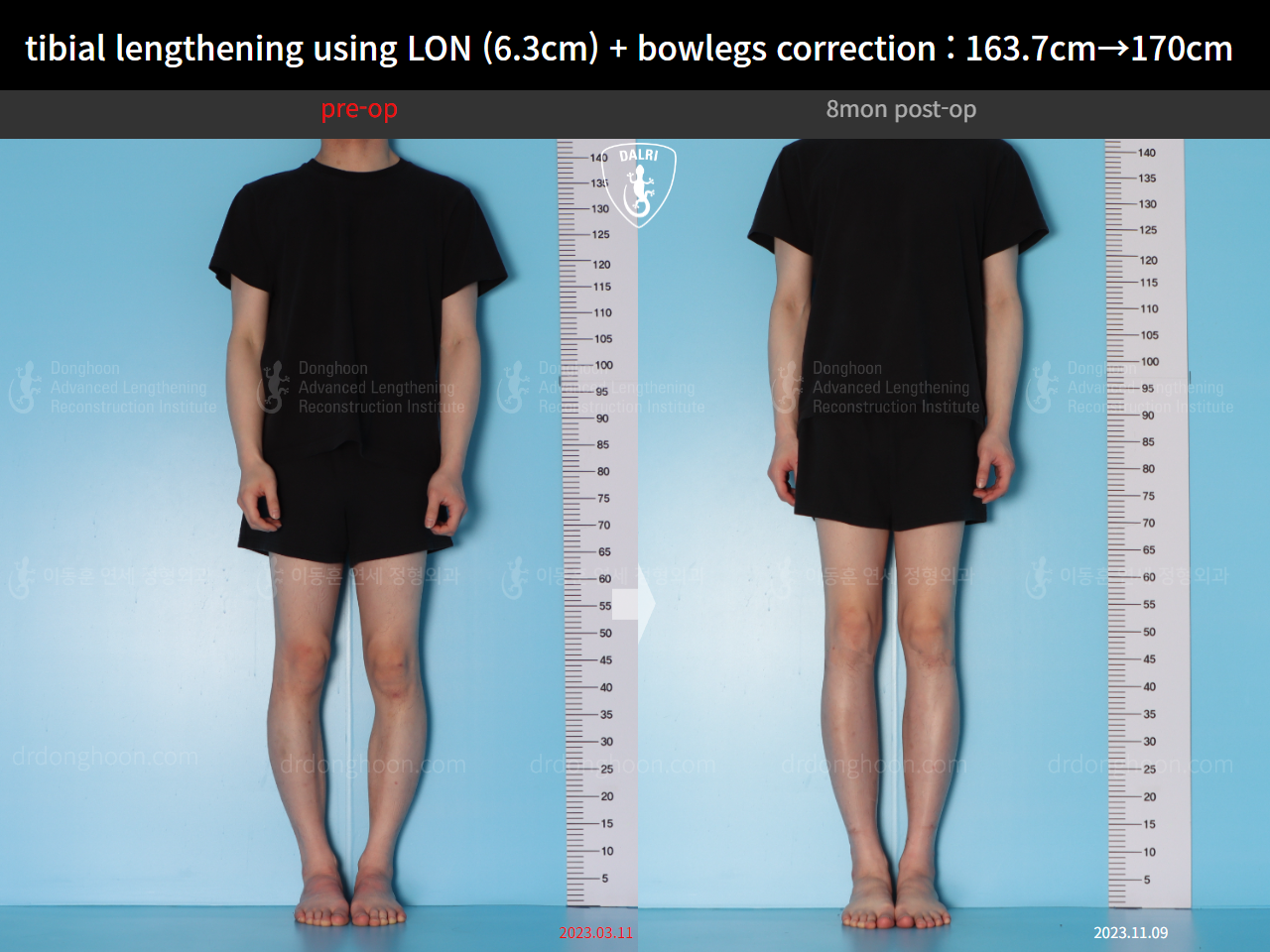 Before and after cll + deformity correction, case 16853829, image 1, Dr. Donghoon institute (DALRI)