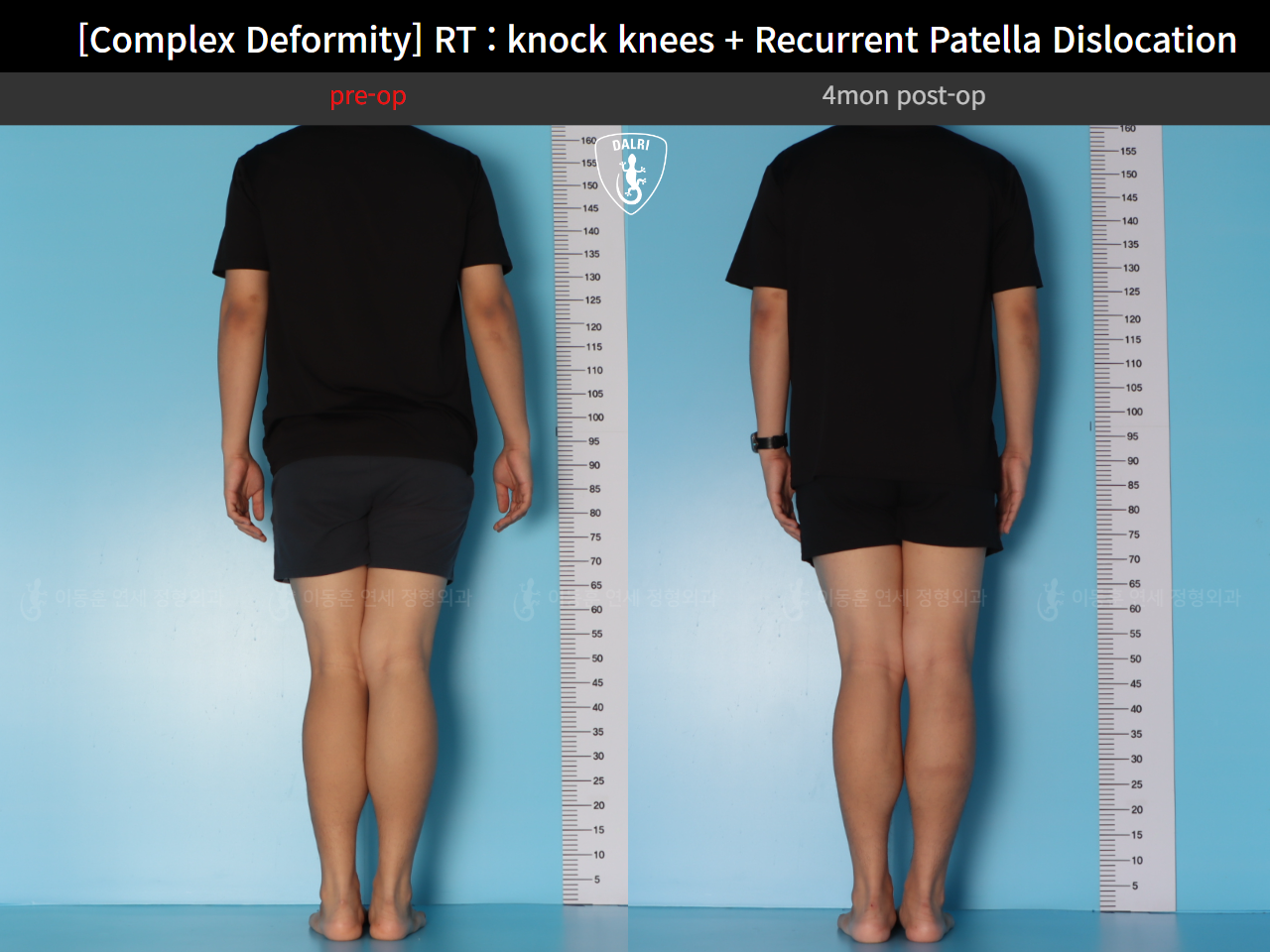Before and after adult knock knees, case 125841800, image 5, Dr. Donghoon institute (DALRI)