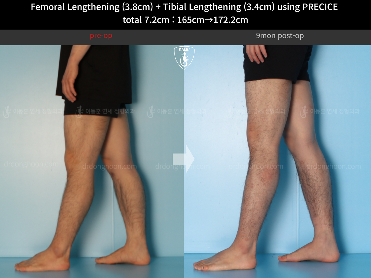 Before and after cll precice, case 14220657, image 10, Dr. Donghoon institute (DALRI)