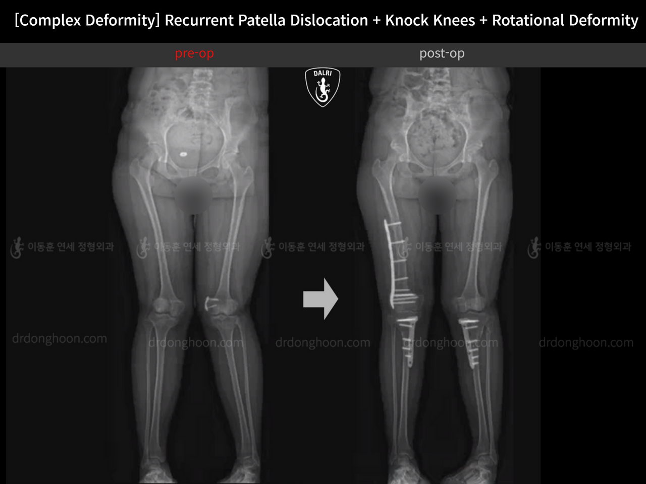 Before and after recurrent patella dislocation, case 14344405, image 8, Dr. Donghoon institute (DALRI)