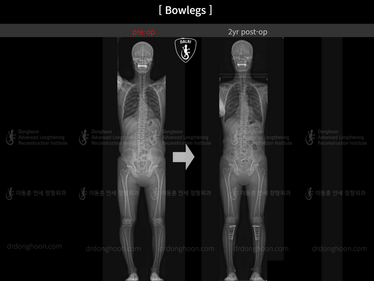 Before and after adult bowlegs, case 14445187, image 6, Dr. Donghoon institute (DALRI)