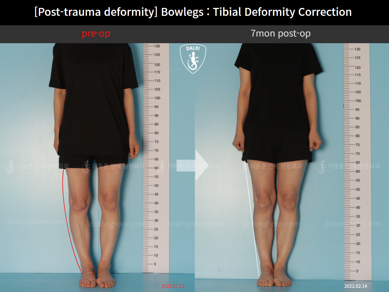Before and after osteotomy for knee osteoarthritis, case 10389290, image 3, Dr. Donghoon institute (DALRI)