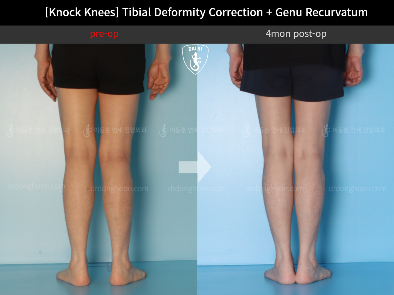 Before and after adult knock knees, case 12846255, image 5, Dr. Donghoon institute (DALRI)