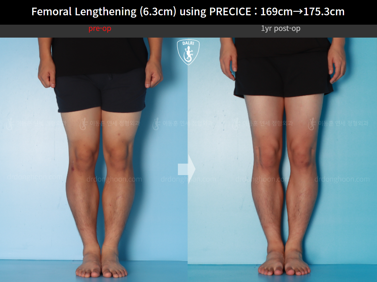 Before and after cll precice, case 16070058, image 9, Dr. Donghoon institute (DALRI)
