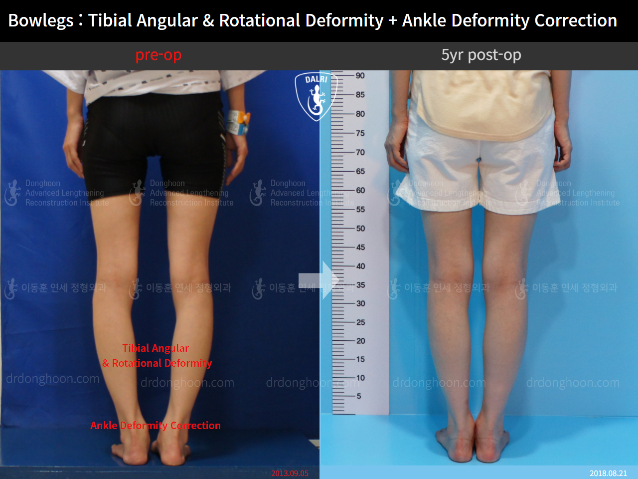 Before and after adult bowlegs, case 4311377, image 4, Dr. Donghoon institute (DALRI)