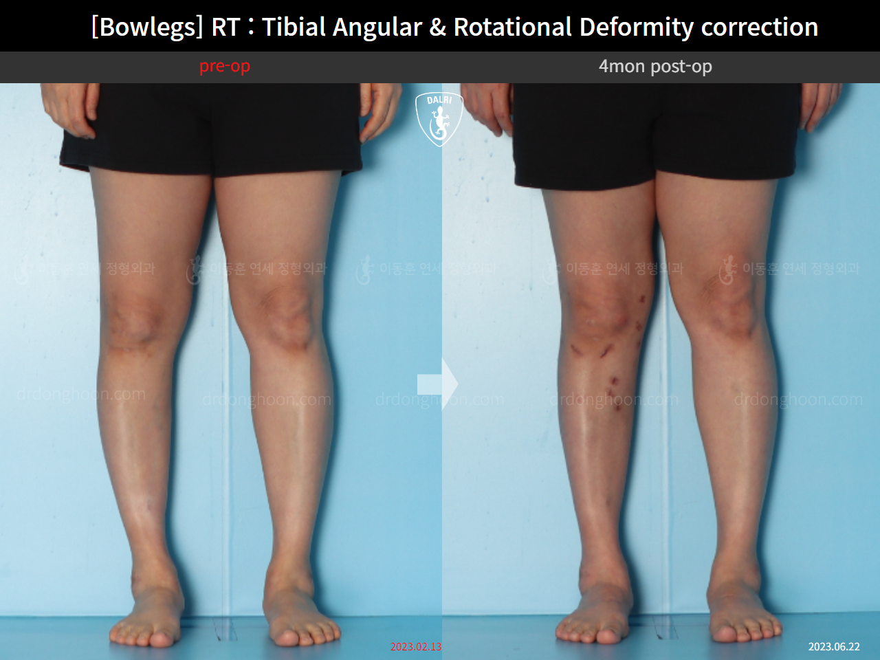 Before and after adult bowlegs, case 15741874, image 8, Dr. Donghoon institute (DALRI)