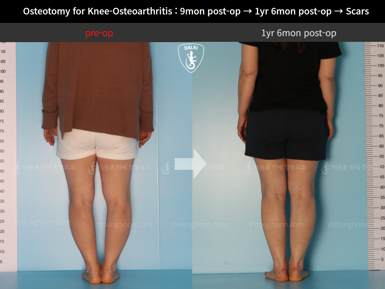 Before and after osteotomy for knee osteoarthritis, case 11203744, image 4, Dr. Donghoon institute (DALRI)