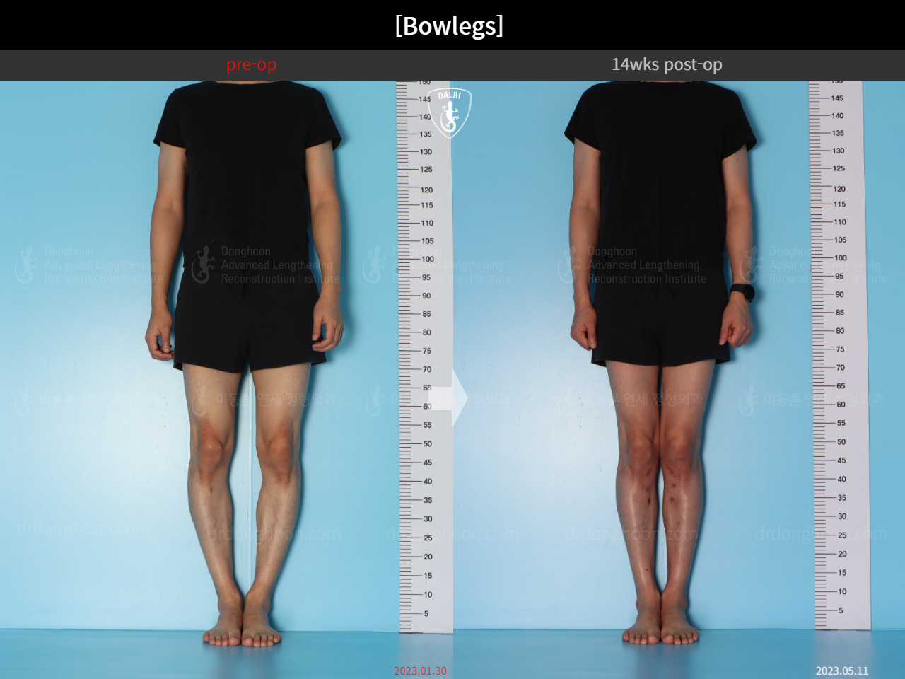 Before and after adult bowlegs, case 15512423, image 1, Dr. Donghoon institute (DALRI)